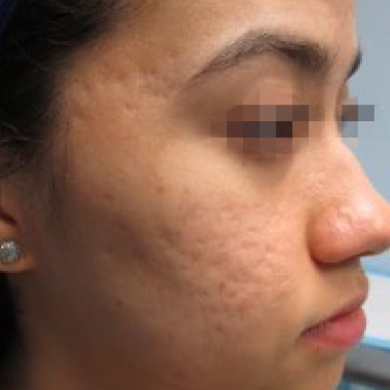 De-identified close-up clinical photograph of facial skin texture