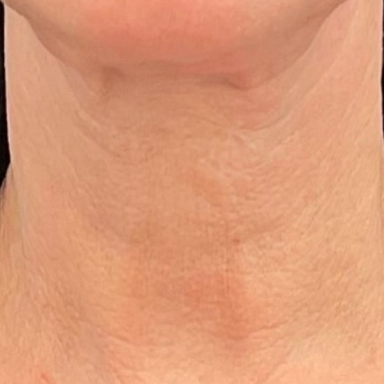 De-identified close-up clinical photograph of neck skin texture