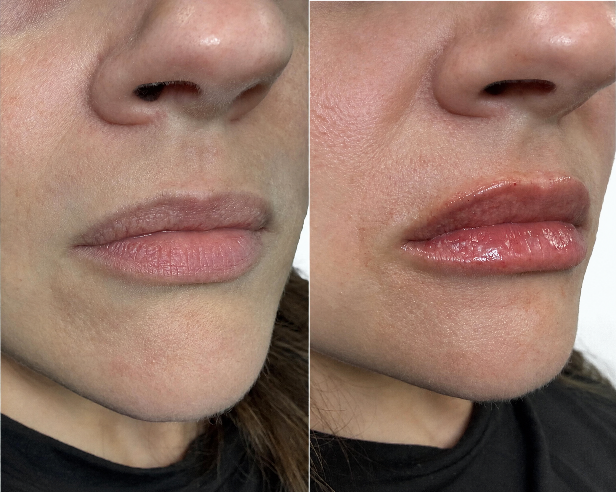 Before-and-after frontal photographs following an individualized lip filler treatment