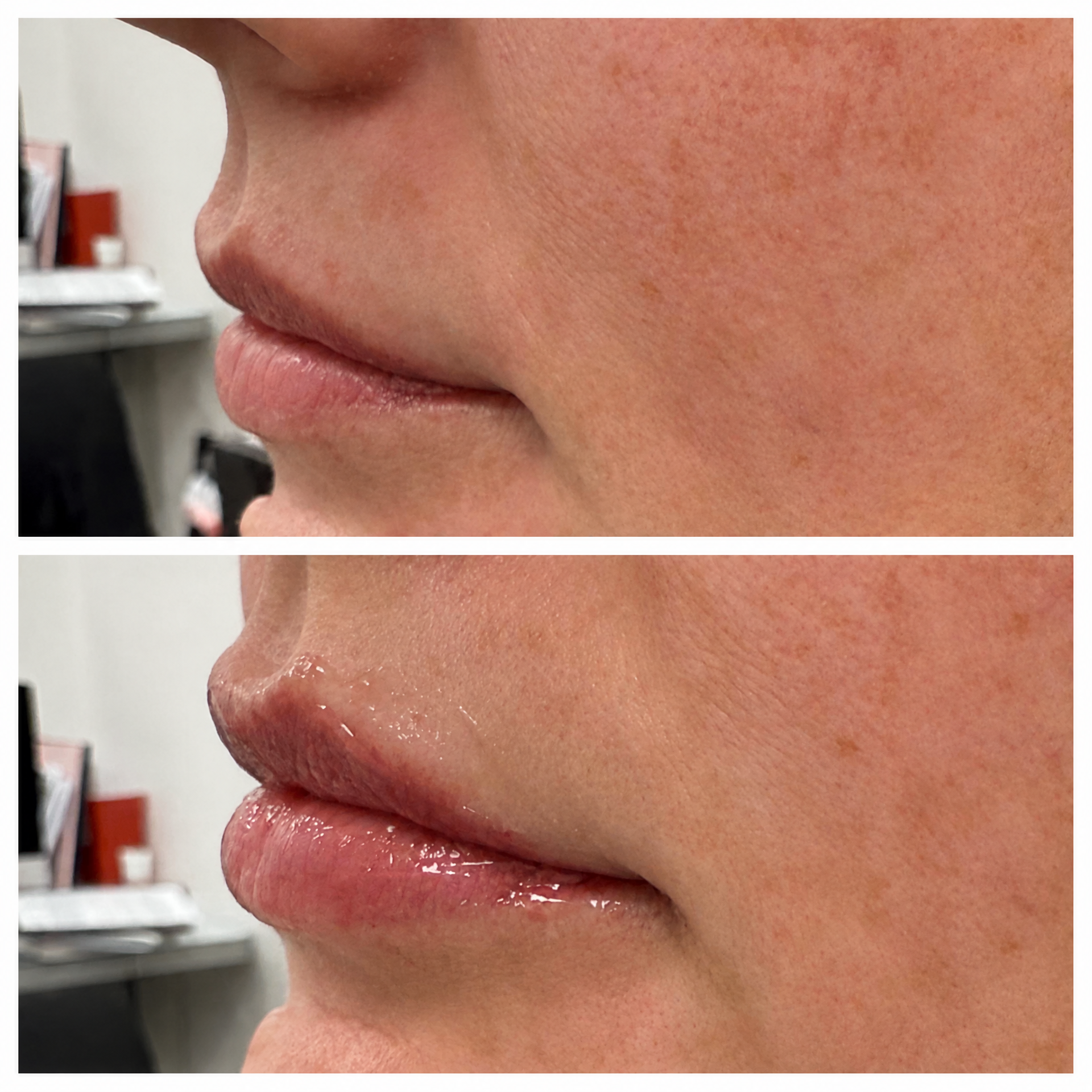 Before-and-after profile photographs following an individualized lip filler treatment