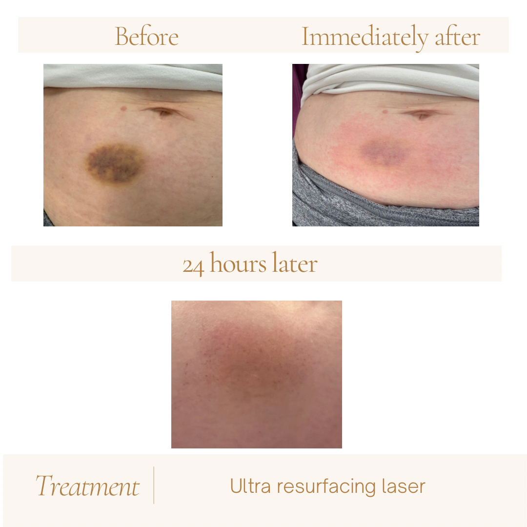 Abdominal skin shown before, immediately after, and 24 hours after an Ultra resurfacing treatment