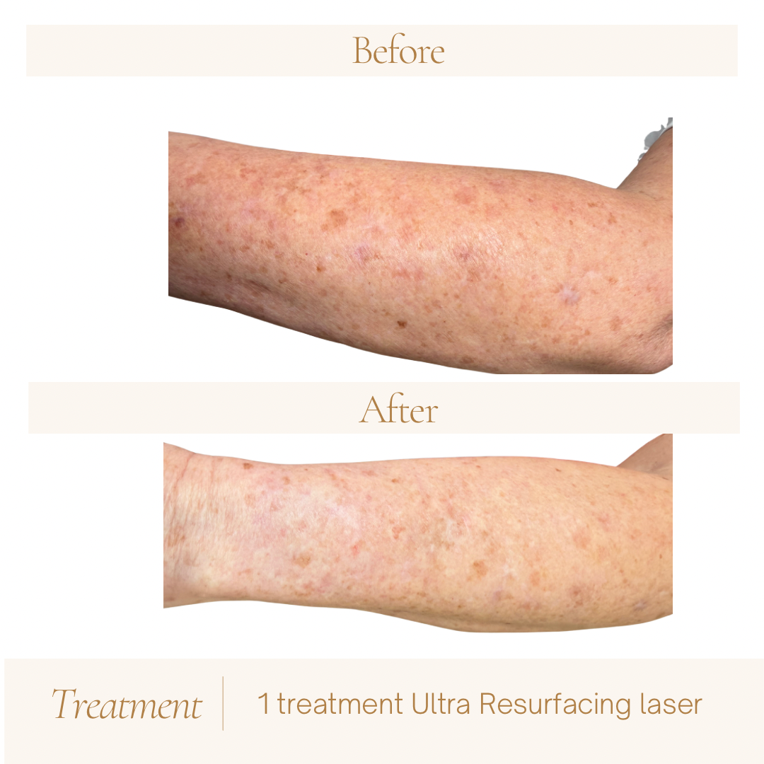 Before-and-after arm photographs following one Ultra resurfacing treatment
