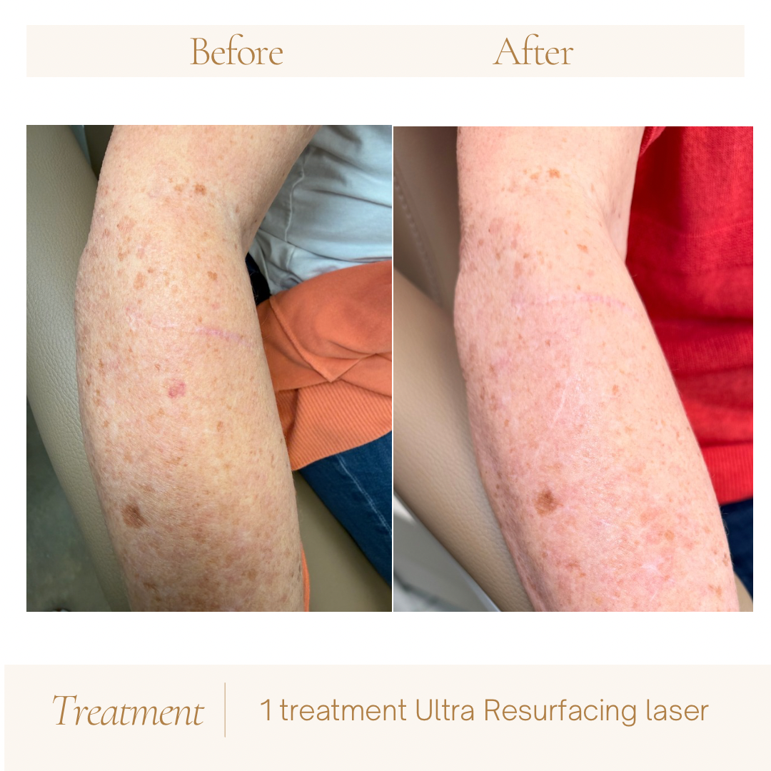 Second before-and-after arm comparison following one Ultra resurfacing treatment