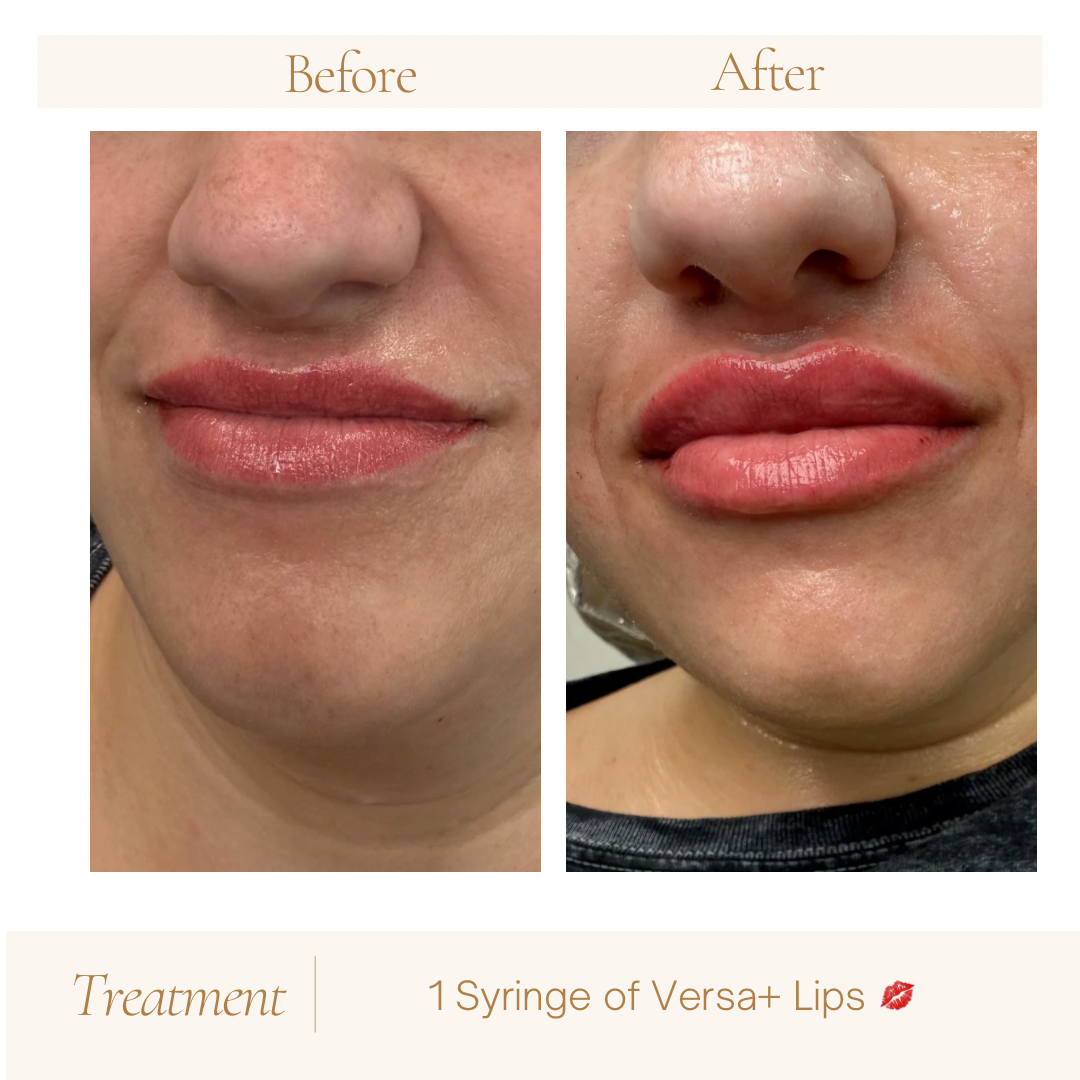 Before-and-after frontal photographs following one syringe of Versa+ lip filler